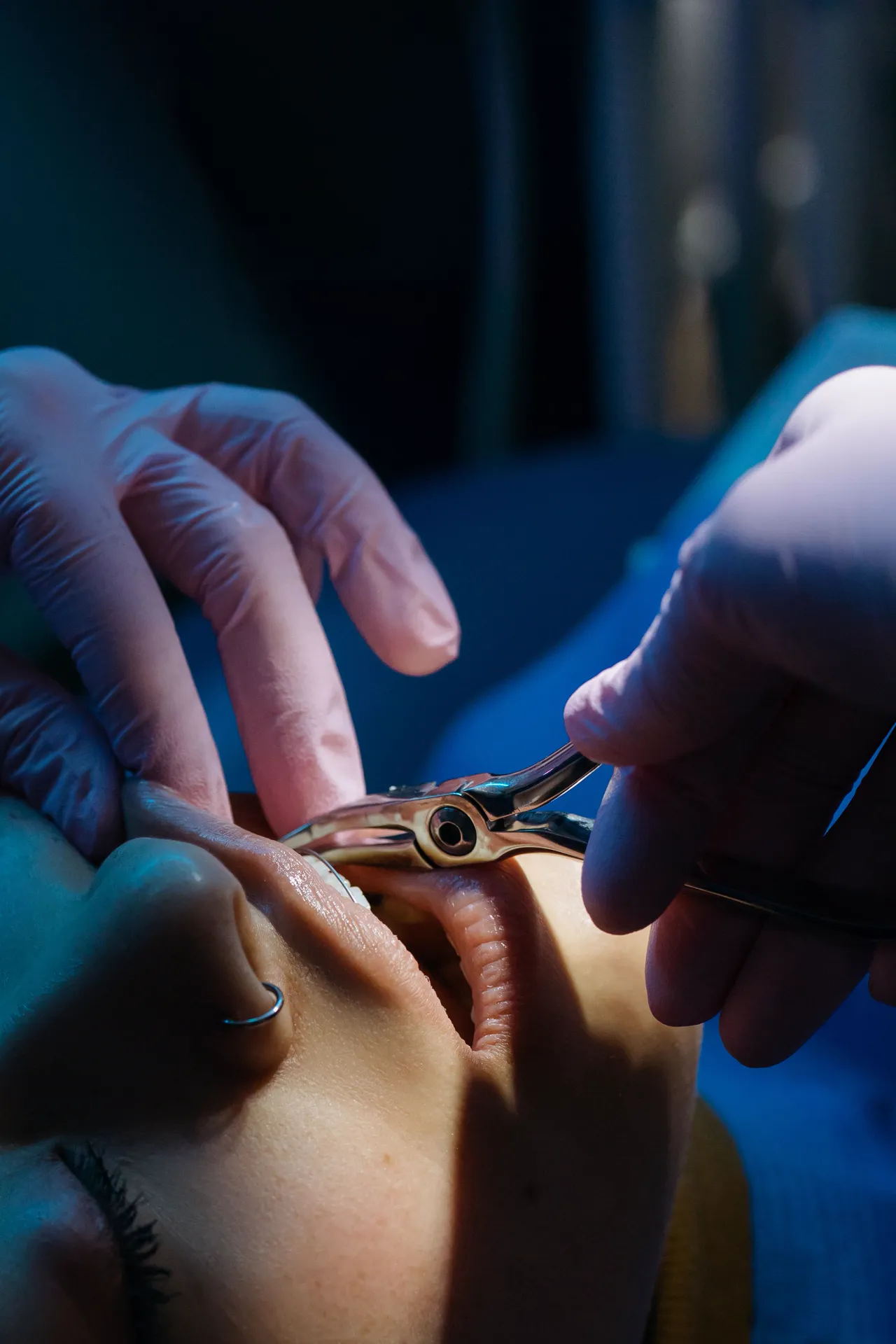 A close view of dental forceps and a patient during a procedure