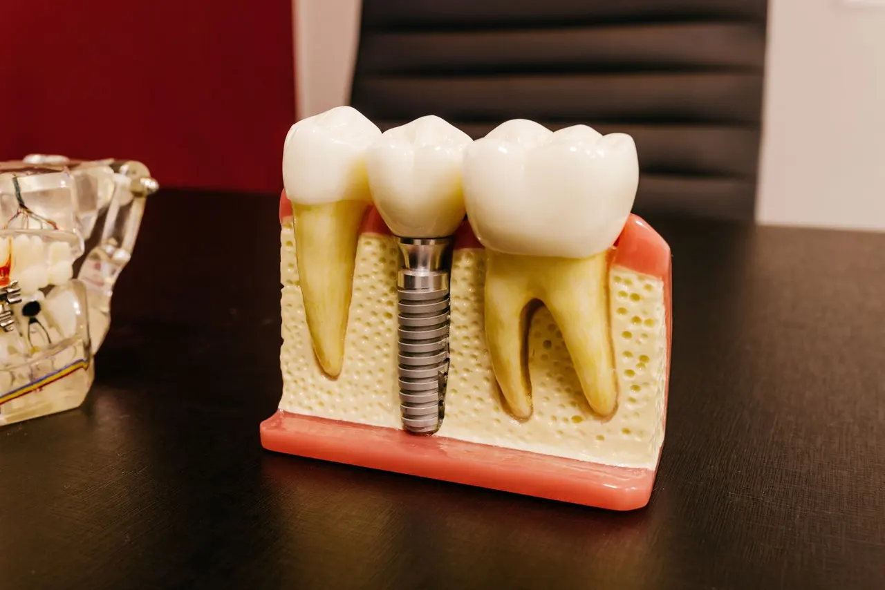 A cross-section model of a dental implant supporting a crown between two natural teeth